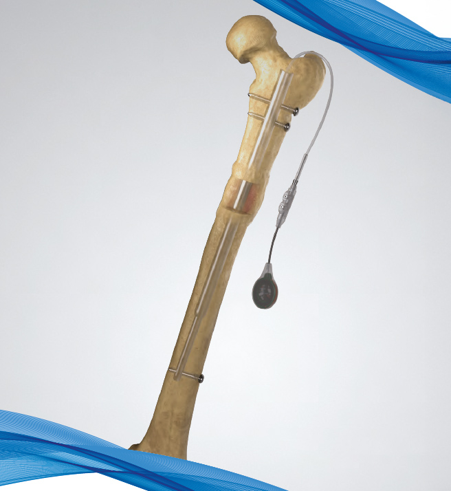 fitbone femur antegrade
