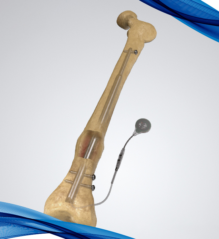 Fitbone Femur Retrograde